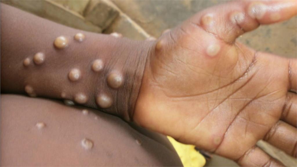 新加坡發現首例猴痘病例。圖／翻攝自WHO