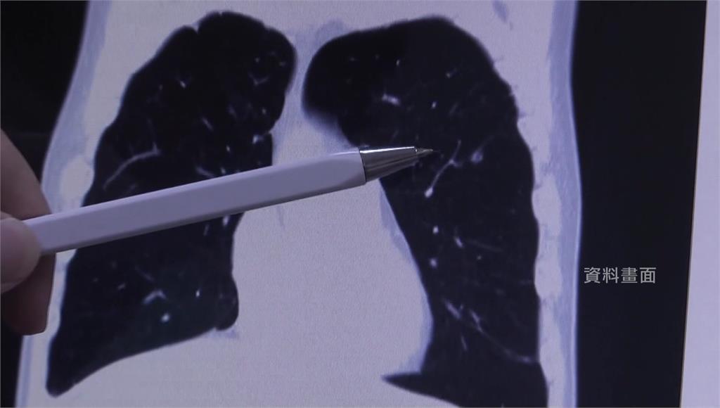 吳淡如發現肺部有20顆小於0.5公分的白點。圖／台視新聞（示意圖，非新聞事件本人）