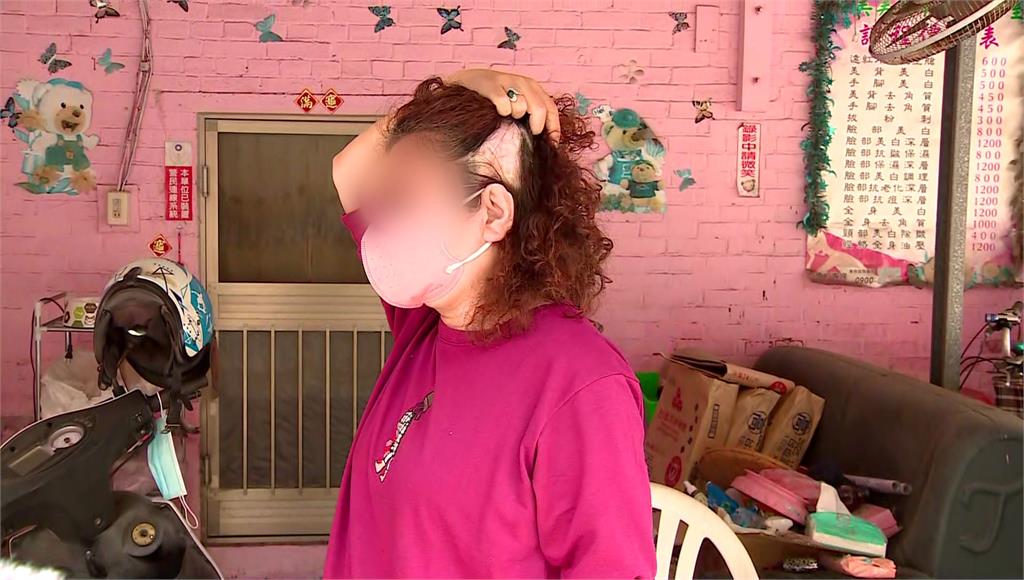 江姓婦人頭皮遭三度燙傷植髮手術也無法恢復。圖／台視新聞