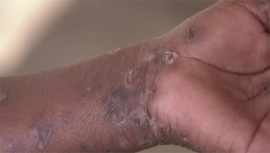 M痘4月新增2例！皆因「不特定性行為」染疫  個案較去年同期增一倍