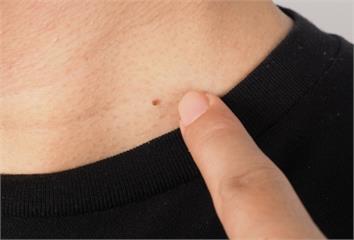 脖子、腋下長小肉芽？醫揭「可能原因」 這類人最好...
