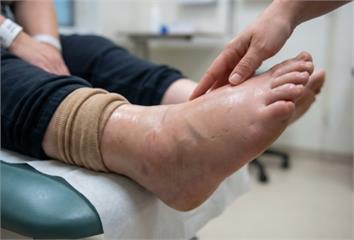 婦癌術後腳腫像「麵龜」！ 醫揭淋巴水腫早期警訊與治療關鍵