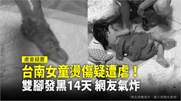 台南女童燙傷疑遭虐  雙腳發黑潰爛14天！社會局...