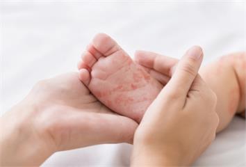 玫瑰疹是什麼？嬰幼兒高燒後出紅疹　症狀、傳染途徑...