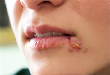 嘴角裂、紅腫...是「唇皰疹or嘴角炎」？專家揭...