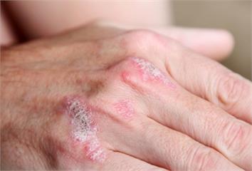 乾癬好發秋冬！醫師解析2大典型症狀與4種易惡化情...