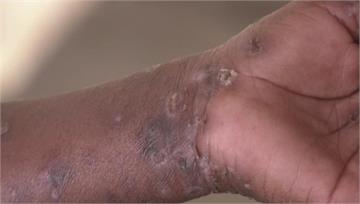 M痘4月新增2例！皆因「不特定性行為」染疫  個案較去年同期增一倍