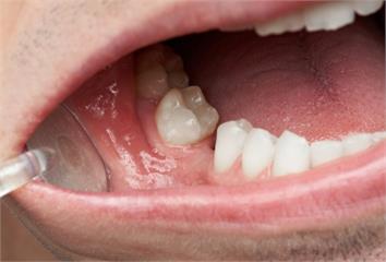缺牙不治療營養不良風險高3.2倍   增加「這疾...
