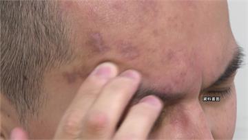 閃兵奇招公開！從精神到視力都能裝 點眼藥水「加深...