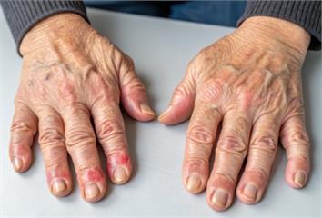 類風濕性關節炎「不痛不代表好」專家提醒骨侵蝕可悄...