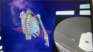 胸壁5.1公分腫瘤 3D列印輔助精準動刀