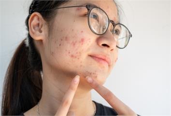 臉上狂冒痘？皮膚科醫曝「這天數」內消除才能不留痕...