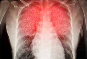不抽菸也罹肺癌？專家揭「最常忽略的致癌陷阱」 你...