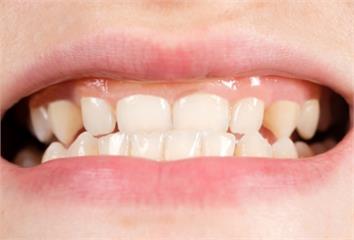牙齦退縮不敢開口笑該如何補救？牙醫盤點常見4原因...