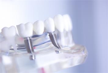 人工植牙後如何保養？延長使用壽命全攻略