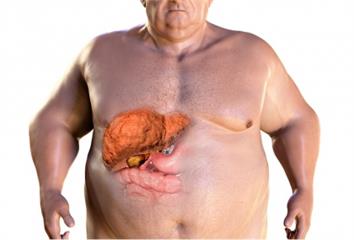 明明很瘦卻有脂肪肝　問題可能出在「2食物」