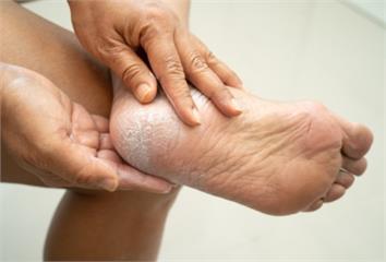 腳後跟總是乾裂、粗糙？醫揭4大原因 「這1種」恐...