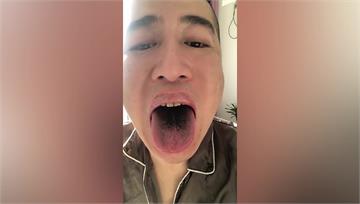 陸民眾疑染疫後舌、臉發黑 上海某醫院示警「年底全...