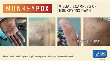 猴痘疫情全球擴散 專家：靠「黏膜接觸」傳染