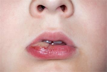治療嘴破有「4方法」 牙醫師提醒：若超過2週未好...