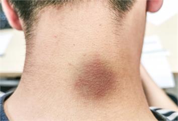 身體「這3處變黑」恐是血糖失控！ 醫嚴厲警告