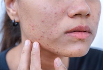 青春痘影響不只是外表！7成青少年自信、人際受挫 ...