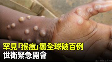 罕見「猴痘」迅速在11國現蹤、全球病例破百　世衛...