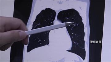 癌症時鐘快轉14秒！每3分48秒就1人罹癌 肺癌...