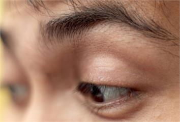眼皮「這1變化」恐是心肌梗塞前兆　很多人以為只是...