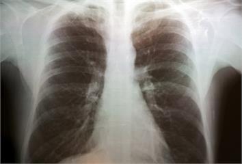 肺炎鏈球菌創6年新高！專家揭「13價+23價疫苗...