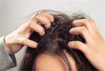 頭皮癢、出油、頭皮屑反覆？ 醫揭1疾病才是真兇