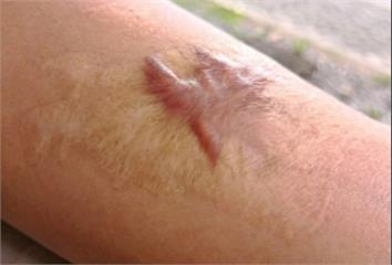 蟹足腫無法根治？掌握這 9 件事 降低發生與惡化...