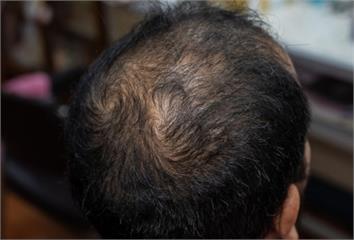 突現「硬幣大小禿髮」恐是圓禿鬼剃頭？ 自體免疫落...