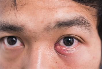 眼皮突然長痘又痛又腫？  醫揭「針眼」5大症狀千...
