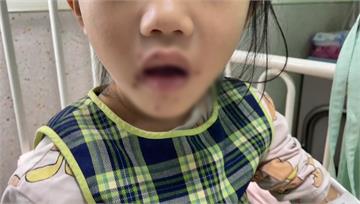 4歲女童長嘴巴長紅疹水泡高燒3天　醫：易誤診為腸...