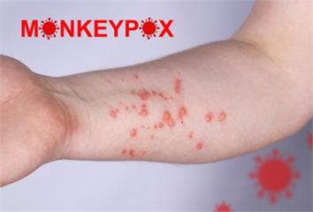 CDC公布44國為猴痘疫情區建議避免前往 「2疫...