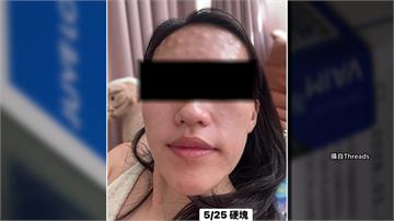 赴韓做醫美變噩夢！女子打素顏針後現結節...額頭...