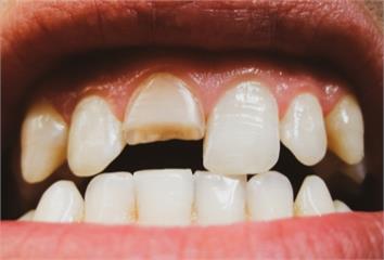缺牙恐致鄰近齒蛀牙！牙醫盤點4招及時處理助改善