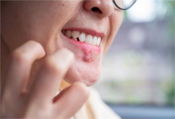 不是火氣大！醫揪「臭嘴角真正元凶」 這營養缺乏最...