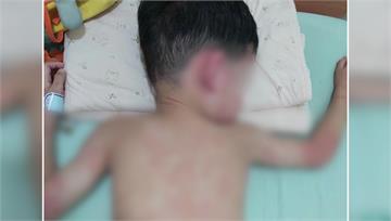 男童腹痛全身長紅疹 竟是類過敏紫斑症惹禍