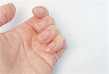 指甲「出現這些變化」別拖！醫示警：恐是腫瘤 白線...