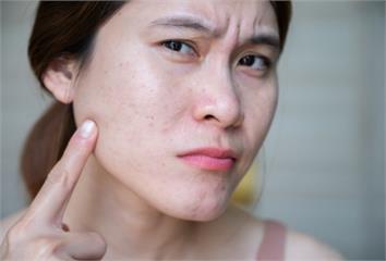 痘痘反覆長？中醫揭「2型濕熱」體質惹禍 下巴長痘...