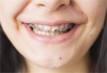 矯正完牙齒出現「黑三角」？醫揭原因  清潔不當恐...