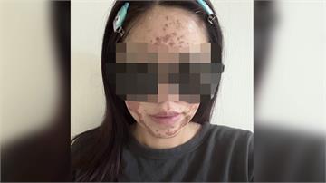 美容師拿錯濃度「40%變70%」 女子做果酸換膚...