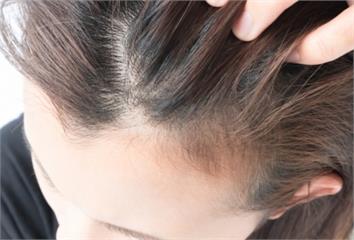 洗頭次數變少反掉更多頭髮？醫揭「真正元凶」　很多...