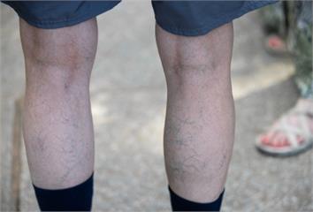 只是站太久？醫揪「靜脈曲張真相」  小心便秘也是...