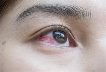 別以為是眼睛疲勞！醫警告「這些症狀」恐是虹彩炎發...
