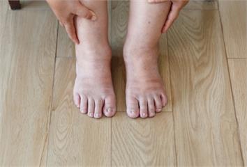 看起來圓不是一定胖！醫教1招判斷「水腫or脂肪」...