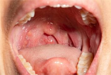 嘴巴出現6種徵狀小心是癌警訊！  嘴破、牙齒動搖...
