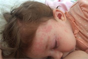 小小紅疹別輕忽！ 8歲童以為被蚊子咬竟是水痘感染